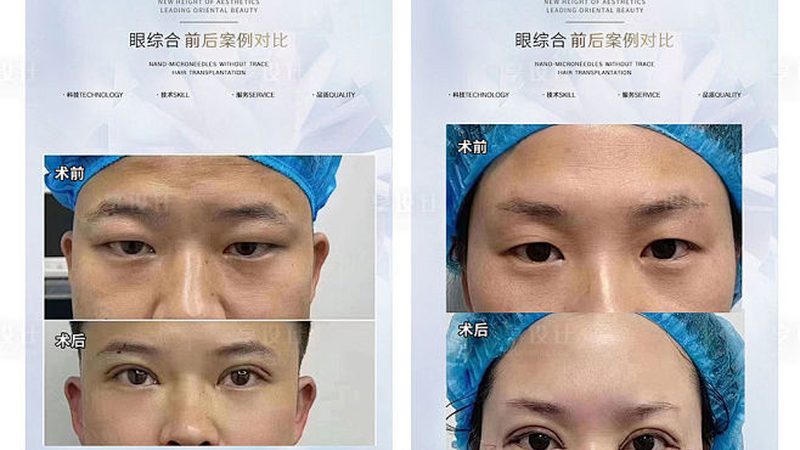 超声炮术后面膜敷贴指南：恢复期护肤攻略