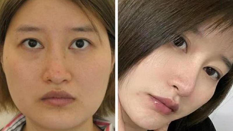 成都瘦腿针：揭秘正规医院选择与注射要点