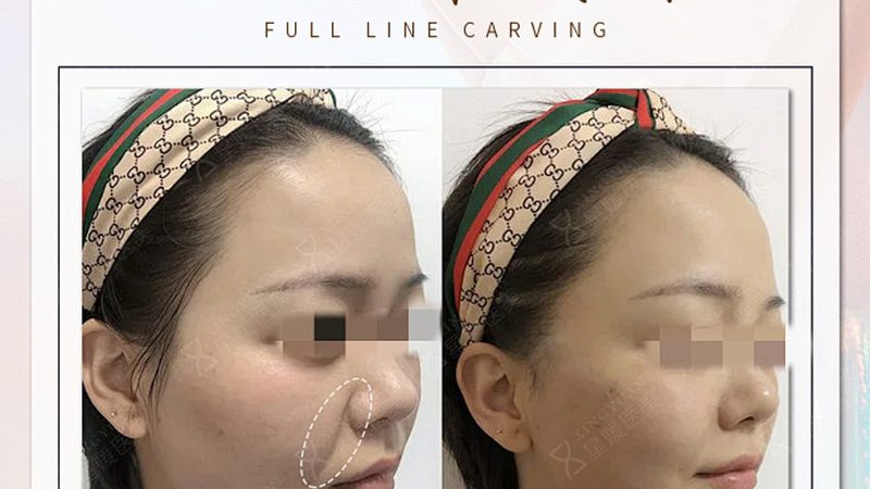 微整形与手术整形：不同需求，不同选择