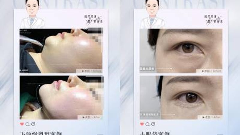 上海隆鼻医生鼻尖塑形技术：揭秘不同术式的特点与选择