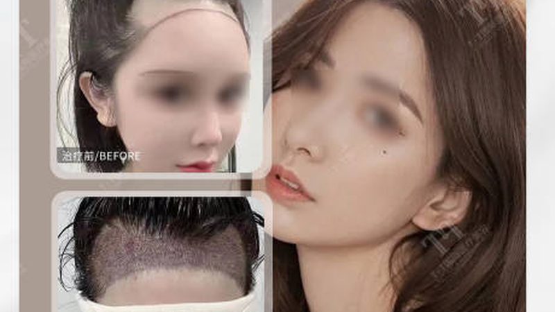 抗衰干细胞治疗，揭秘其价格背后的真相