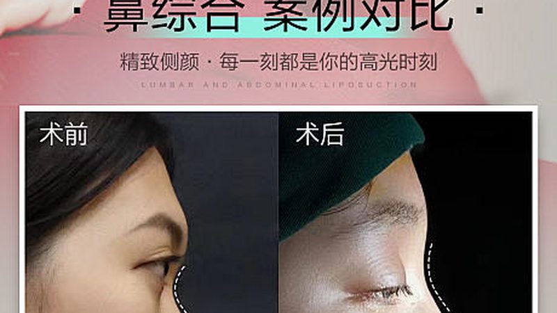 重庆面部轮廓整形恢复期揭秘：了解真实恢复过程