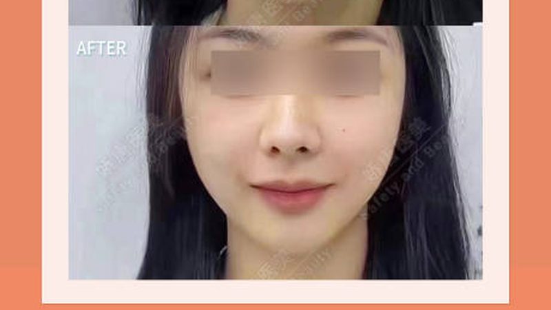 轻医美项目：男士的美丽新选择
