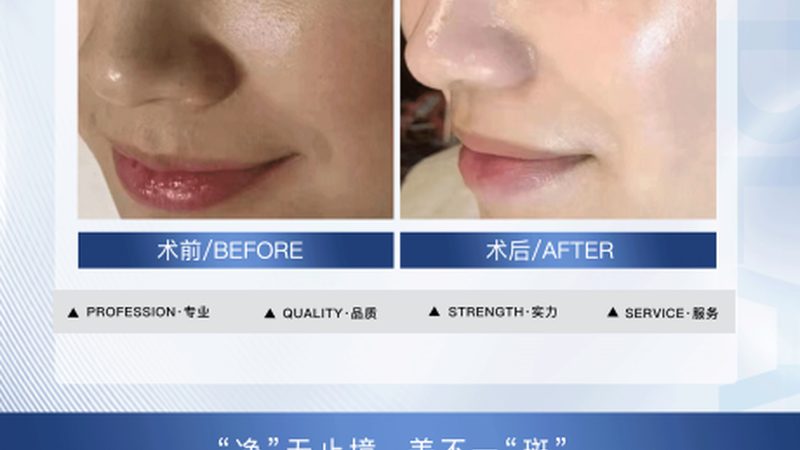 热玛吉仪器报价单揭秘：如何识别正规与陷阱