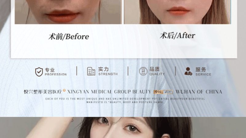 肉毒素除抬头纹，揭秘北京优质医院选择要点