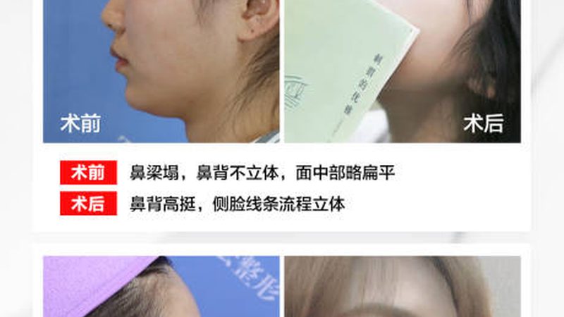 光子嫩肤仪蓝光祛痘，效果如何？揭秘原理与操作要点
