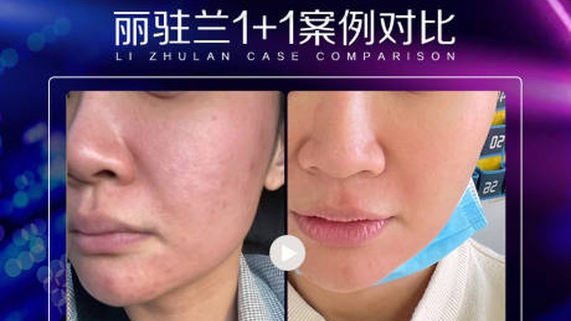 小标题：双眼皮手术，了解这些是关键