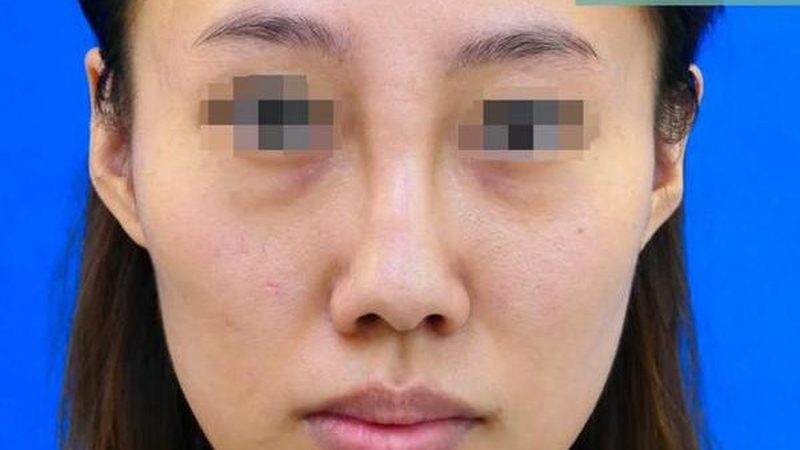 肉毒素去狐臭，效果如何？真实反馈揭秘